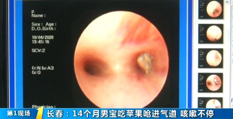 8个月男婴吃苹果被呛死,婴儿4个月吃苹果被呛