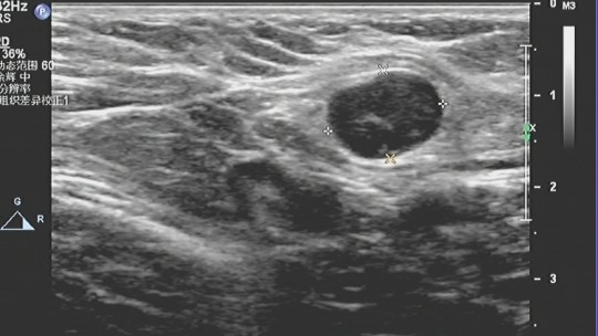 乳腺癌彩超能看出淋巴异常吗,乳腺结节和乳腺癌彩超区别