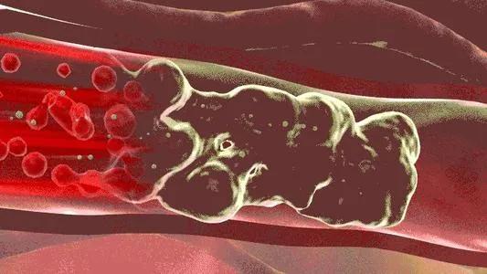 一产妇手术台上大出血死亡,一产妇大出血急需血小板去世