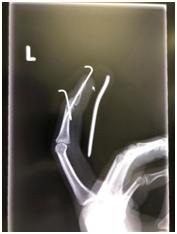 在日本骨折的人,日本骨折