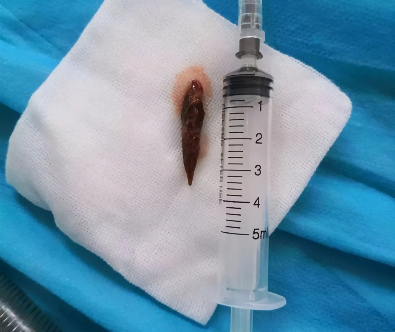 吃枣核的危险期,误食红枣核之后该注意什么