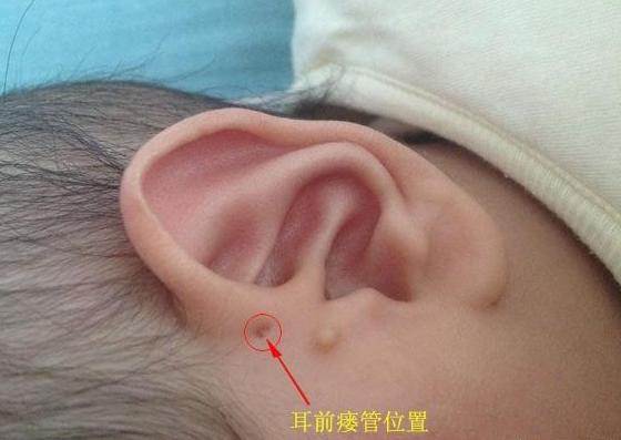小孩耳朵有小孔好吗,孩子耳朵看富贵命