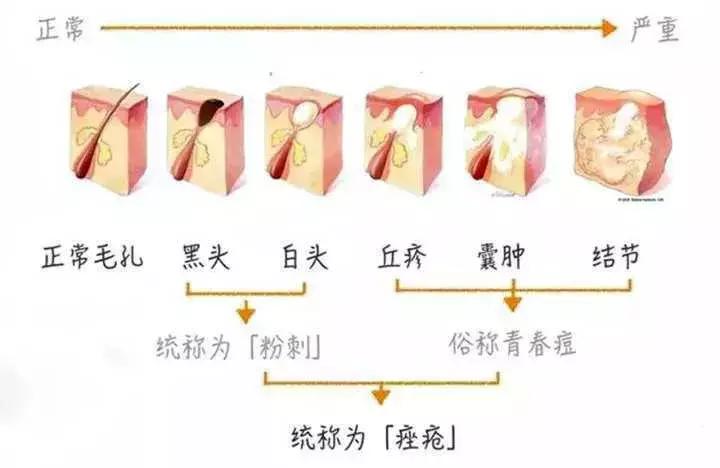 去黑头收缩毛孔草莓鼻,去黑头草莓鼻的护肤品