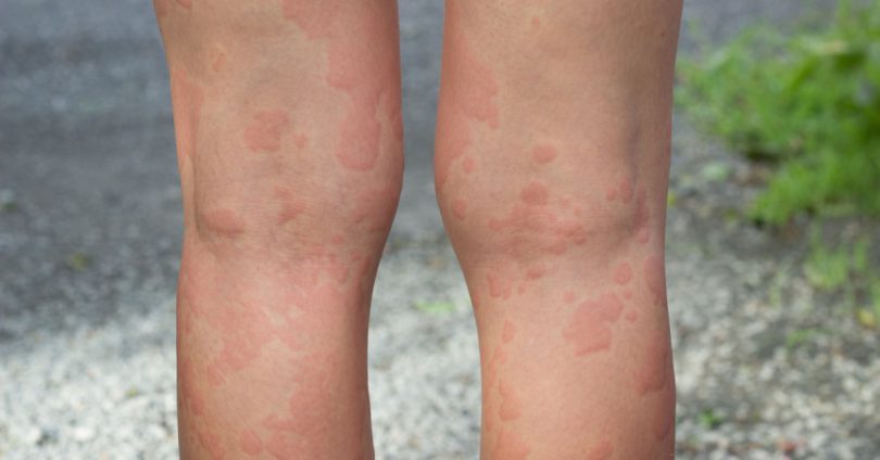 长水痘并发脑炎怎么办,9岁男孩急性荨麻疹是出水痘么