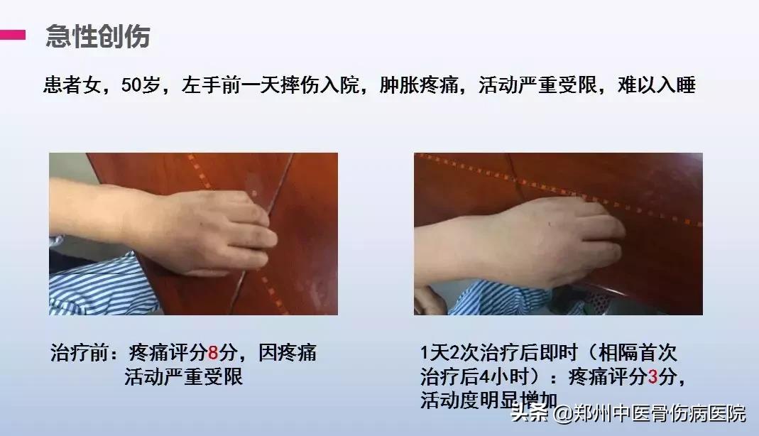 痛与不痛只差一个“低温”的距离—我院最新引进低温冲击疗法！