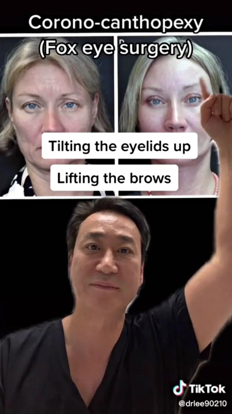 亚洲人“丹凤眼”成西方热门整容项目？一边歧视一边悄悄整容？