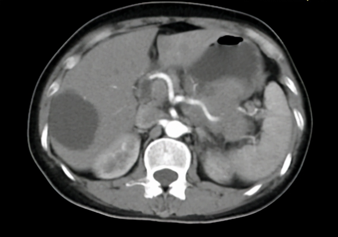 胰腺腺鳞癌手术后能生存几年,胰腺腺癌与胰腺鳞癌