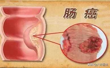 便血是怎么回事大肠癌,便血就是肠癌吗