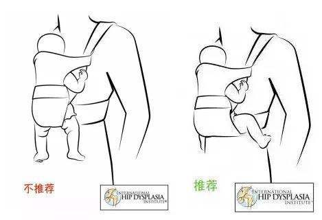 宝宝皮纹不对称腿好像粗细不一样,婴儿皮纹不对称多大治疗效果最好