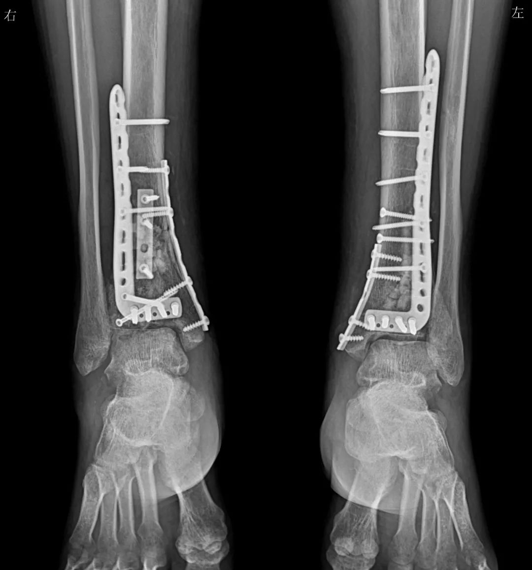 科普丨什么是Pilon骨折？