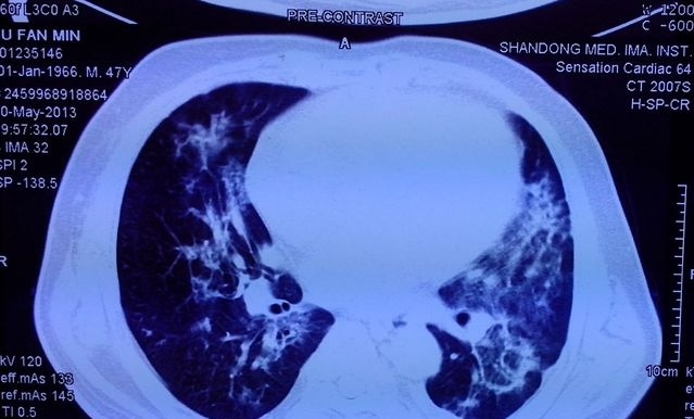 尿毒症并发症治疗,肾内科医生讲述的尿毒症患者