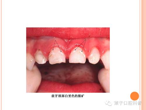 蛀牙治疗科普,蛀牙安全有效的方法