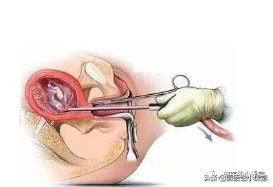 意外怀孕药流和人流哪个伤害小,一年意外怀孕两次还能选择药流吗