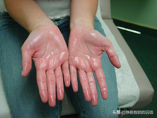 手心脚心容易出汗什么原因,手心为什么总是会出汗