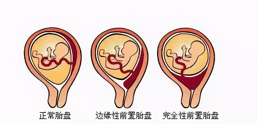 手剥胎盘有多痛可以打麻药不,手剥胎盘会肚子疼吗