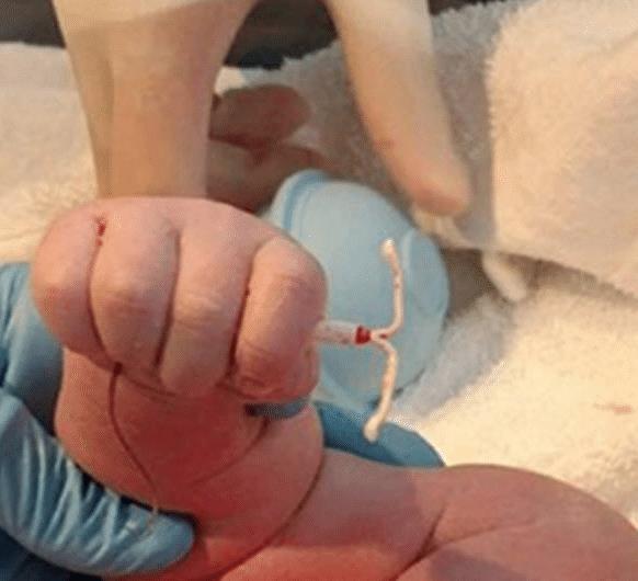 上环后一个月复查需要注意什么,上环取环的相关知识