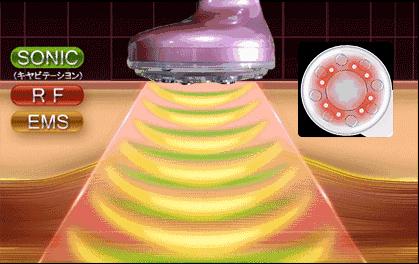 切眼袋会加速衰老的案例,割双眼皮衰老更快