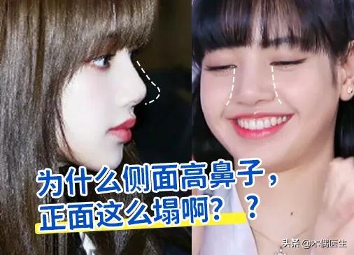 侧面鼻子很挺正面很塌,怎样判断鼻子的塌与挺