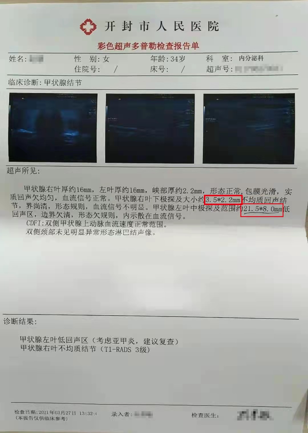 甲状腺结节心慌发热失眠,甲状腺手术成功案例