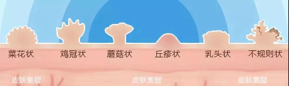 尖锐性湿疣用手抠掉痛吗,尖锐性湿疣可以抠掉吗
