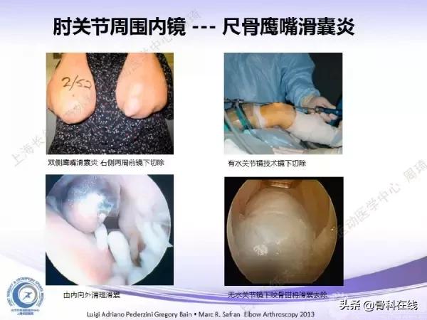 肘关节镜手术后引流,肘关节镜微创手术