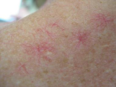 肝硬化出现蜘蛛痣是什么原因,肝硬化有蜘蛛痣的概率有多大