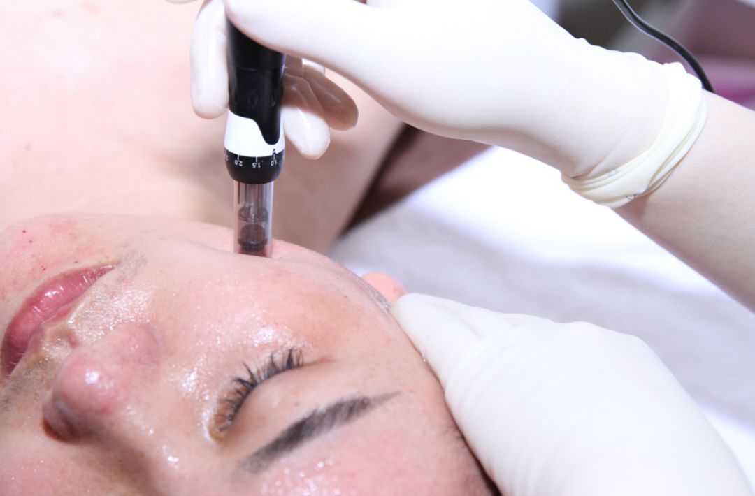 祛痘印最简单有效的方法是什么,去痘印最有效的方法值得收藏