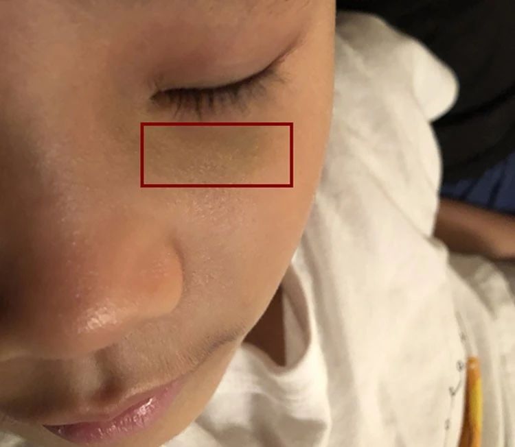 孩子撞伤淤青,小朋友撞淤青应热敷还是冷敷