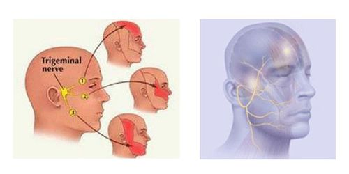 微创穿刺治疗三叉神经痛,三叉神经痛做完微创脸麻正常吗