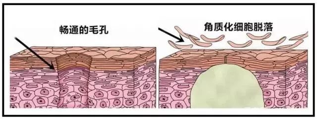 角质层薄去角质有必要吗,角质层薄的皮肤也要定期去角质吗