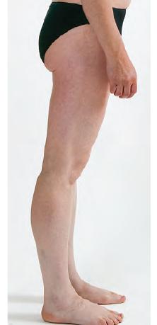 膝过伸自救指南：4个动作帮你改善膝过伸