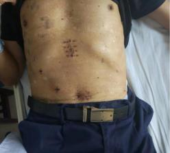 食管恶性肿瘤医生建议手术,84岁的老人食道良性肿瘤能手术吗