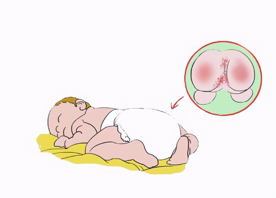 美力源育儿讲堂:宝宝总是会出现红屁股怎么办