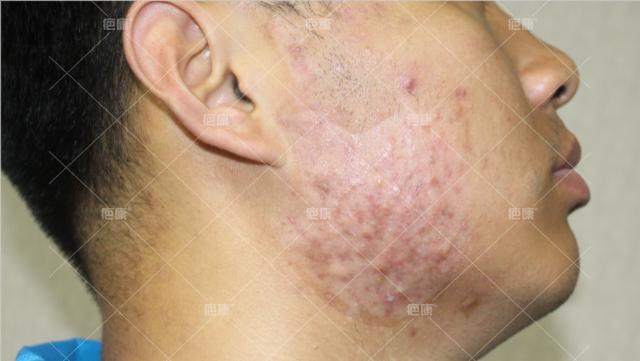 北京疤康治疤痕疙瘩怎么样,疤康治疗疼吗