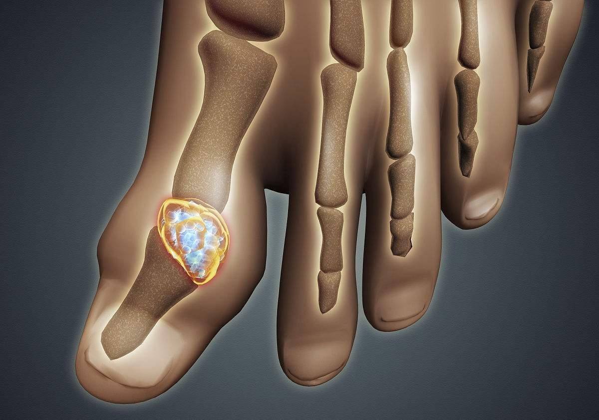 骨关节炎痛风和类风湿都有何症状,痛风关节严重畸形患者能活多久