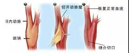 查颈动脉斑块挂什么科,颈动脉斑块的治疗方法