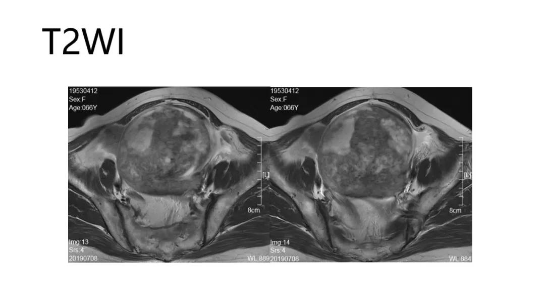 卵巢原发肿瘤的分析思路
