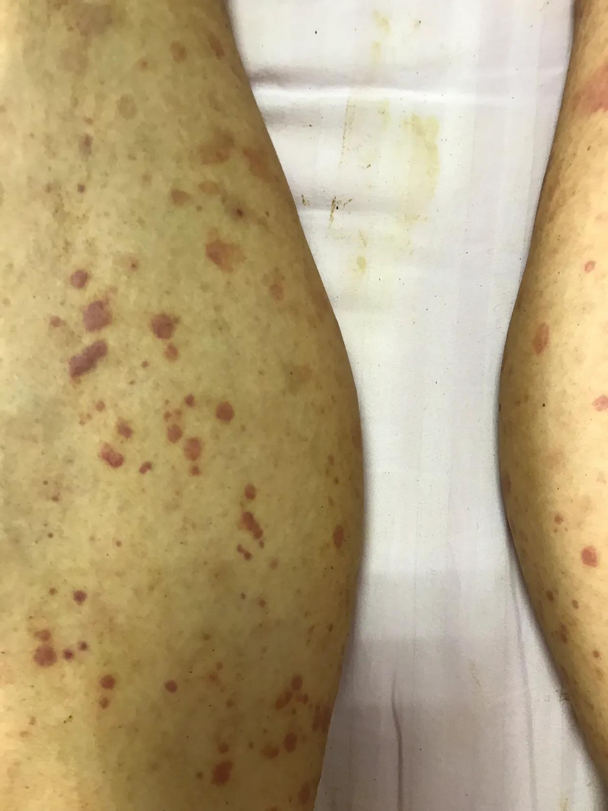 过敏性紫癜的鉴别图片,过敏性紫癜反复出零星小点