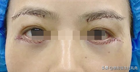 内路法祛眼袋手术效果能保持多久,去眼袋手术警惕三大后遗症