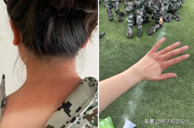 军训后晒黑怎么补救学生党,军训晒黑晒到脱皮应该怎么办