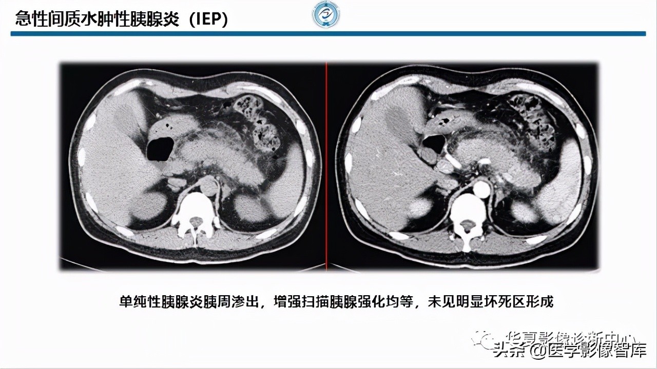 核磁ct都显示急性胰腺炎,急性坏死性胰腺炎的ct表现