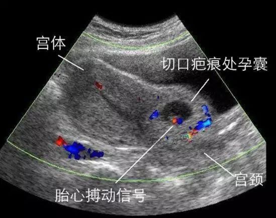 太后悔剖腹产了我该怎么办,剖腹产你们都后悔了吗