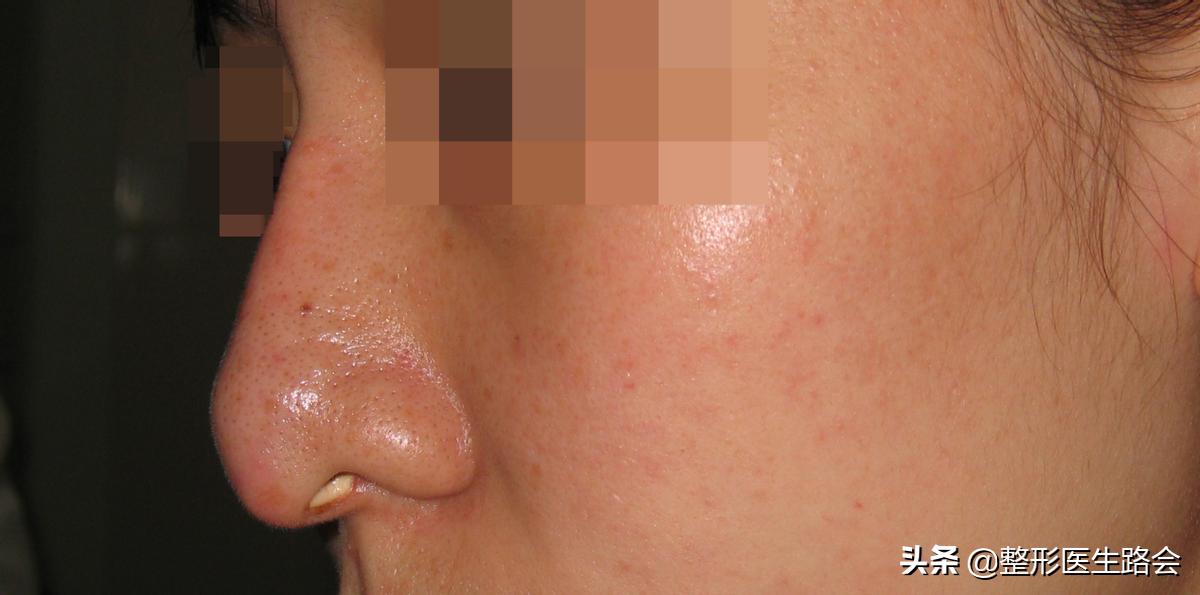 为什么耳软骨只能垫鼻尖不能隆鼻,肋软骨隆鼻时间久了会顶破鼻尖吗