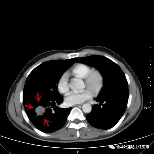 伴有脑转移了的肺癌能手术吗？