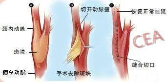 颈动脉斑块有哪些症状和危害,颈动脉有斑块能搓揉吗