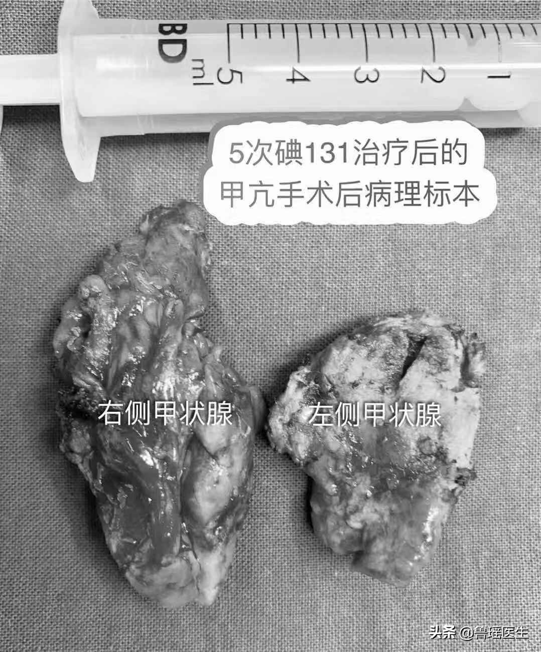碘131治疗3次了tg值为75,碘131治疗后甲状腺功能的变化