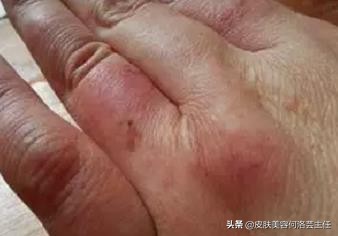 冬天冻疮又痛又痒用什么药喷最好,冻疮又疼又痒怎么缓解