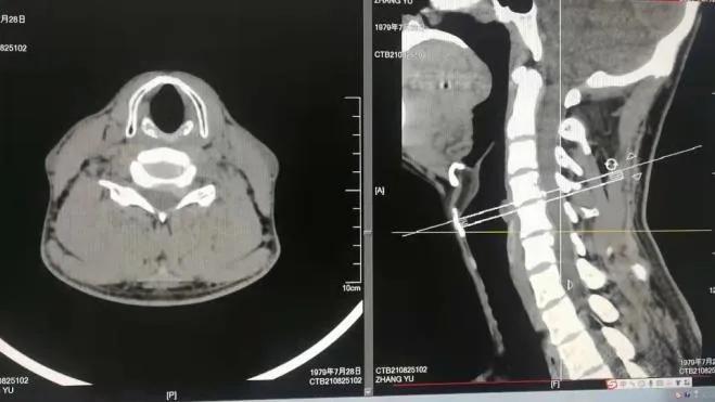 成功开展“钥匙孔”技术治疗颈椎病