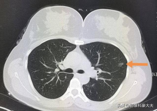 肺癌怎样才算局部晚期症状,肺癌分几种类型怎么吃药