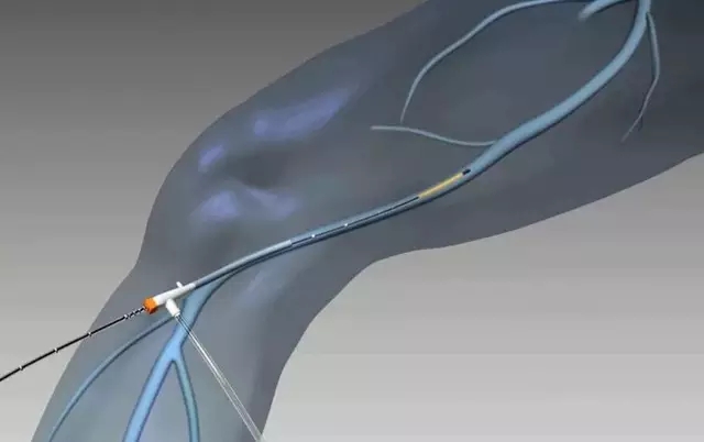 小腿老是发麻有沉重感看什么科,下肢腿部沉重是什么原因造成的